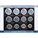 imegenes del estudio tomográfico del paciente: Hematoma extradural frontal izquierdo